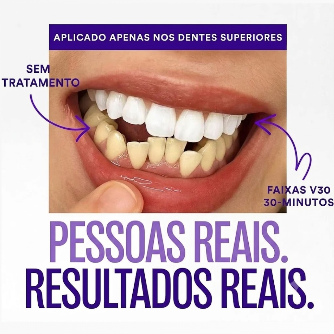 Lumident - Tiras Clareadoras Roxas com Efeito Corretor de Cor